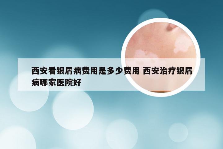 西安看银屑病费用是多少费用 西安治疗银屑病哪家医院好