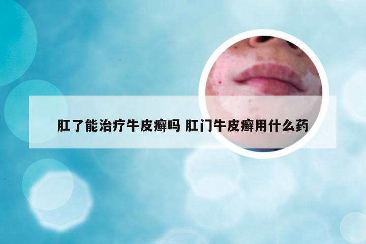 肛了能治疗牛皮癣吗 肛门牛皮癣用什么药