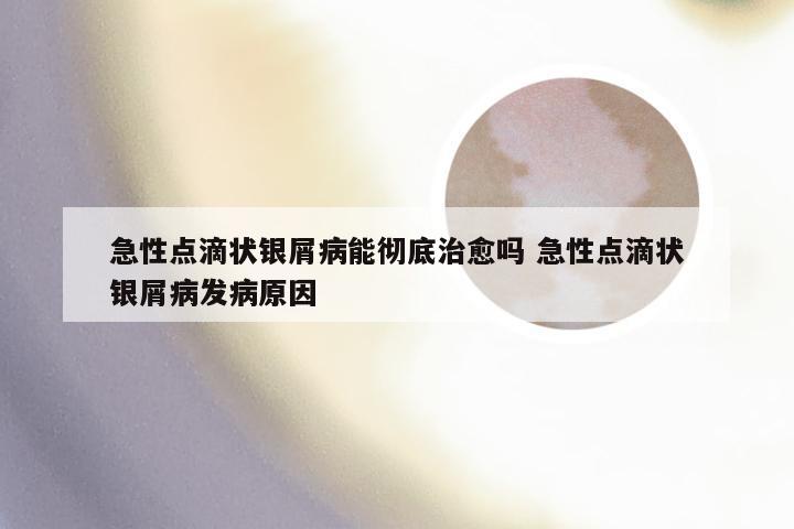 急性点滴状银屑病能彻底治愈吗 急性点滴状银屑病发病原因
