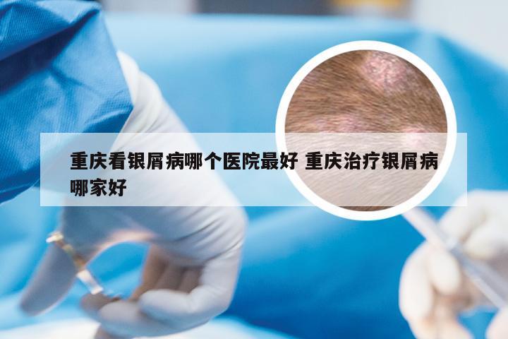 重庆看银屑病哪个医院最好 重庆治疗银屑病哪家好