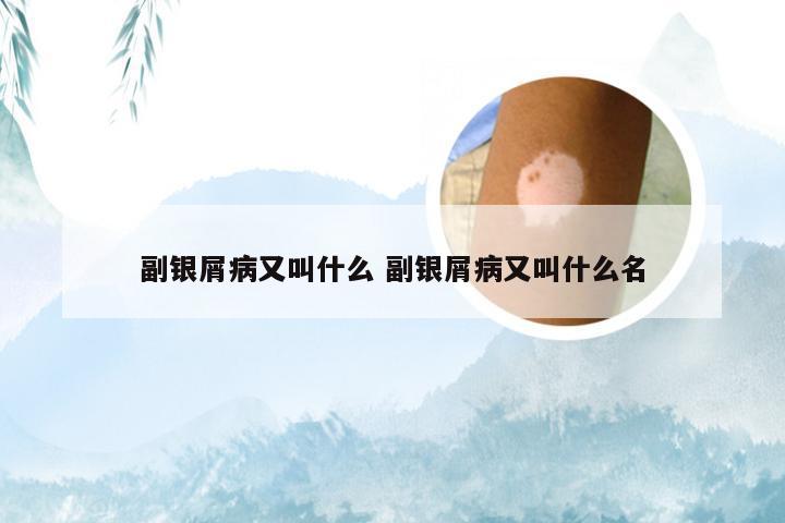 副银屑病又叫什么 副银屑病又叫什么名