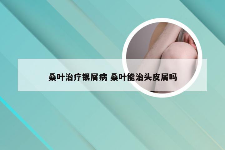 桑叶治疗银屑病 桑叶能治头皮屑吗
