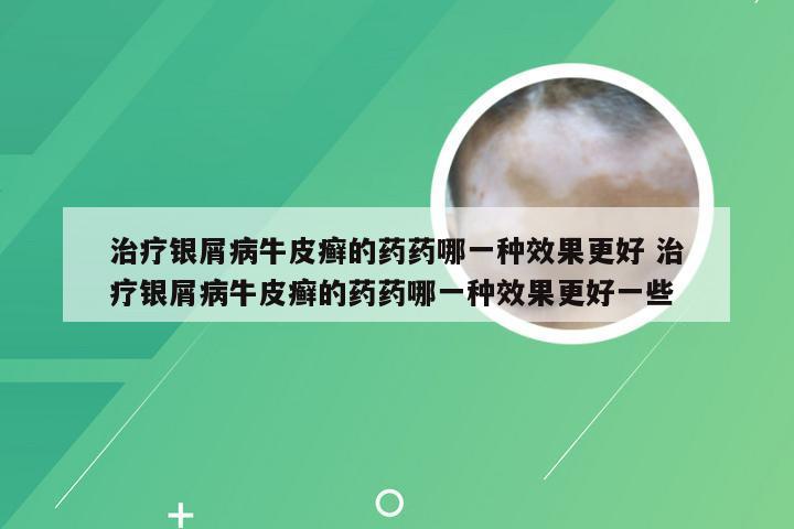 治疗银屑病牛皮癣的药药哪一种效果更好 治疗银屑病牛皮癣的药药哪一种效果更好一些