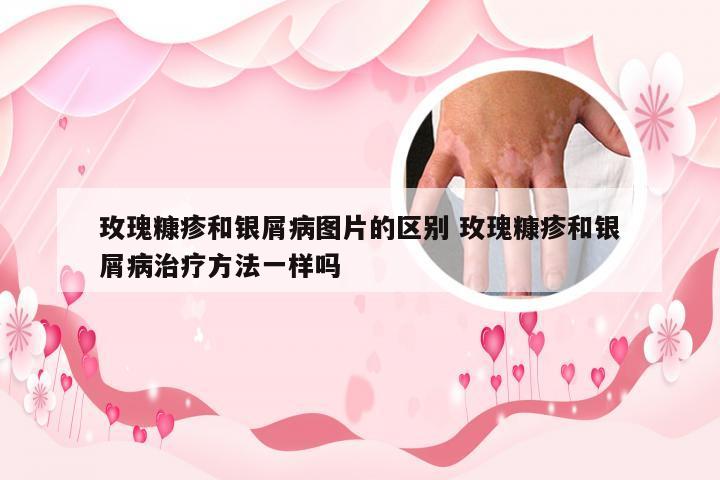 玫瑰糠疹和银屑病图片的区别 玫瑰糠疹和银屑病治疗方法一样吗