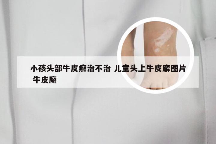小孩头部牛皮癣治不治 儿童头上牛皮廨图片 牛皮廨