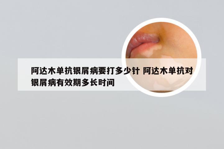 阿达木单抗银屑病要打多少针 阿达木单抗对银屑病有效期多长时间