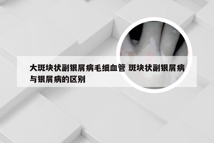 大斑块状副银屑病毛细血管 斑块状副银屑病与银屑病的区别