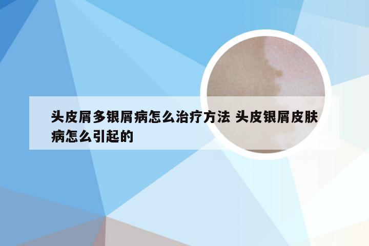 头皮屑多银屑病怎么治疗方法 头皮银屑皮肤病怎么引起的