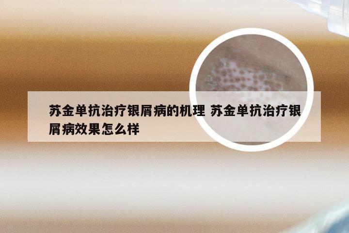 苏金单抗治疗银屑病的机理 苏金单抗治疗银屑病效果怎么样