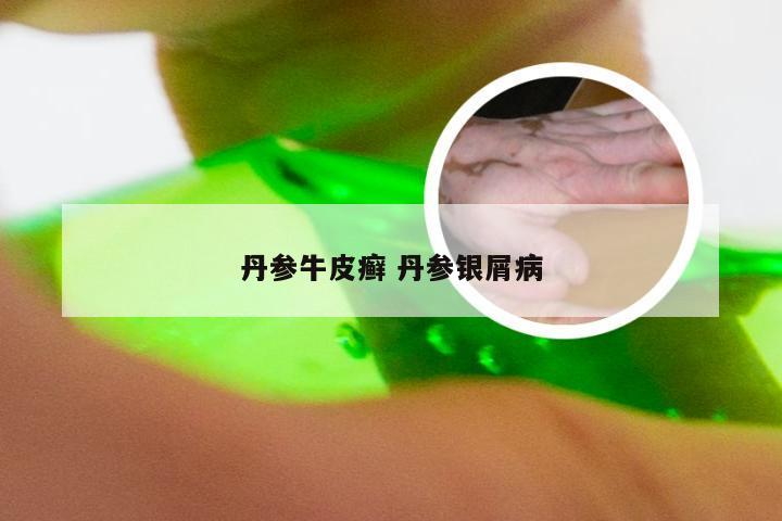 丹参牛皮癣 丹参银屑病