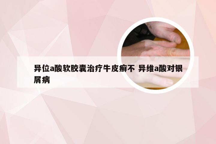 异位a酸软胶囊治疗牛皮癣不 异维a酸对银屑病