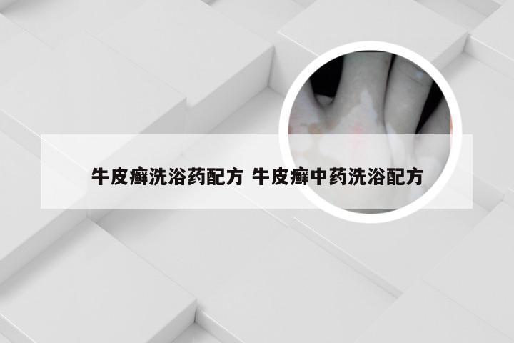 牛皮癣洗浴药配方 牛皮癣中药洗浴配方