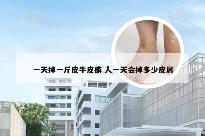 一天掉一斤皮牛皮癣 人一天会掉多少皮屑