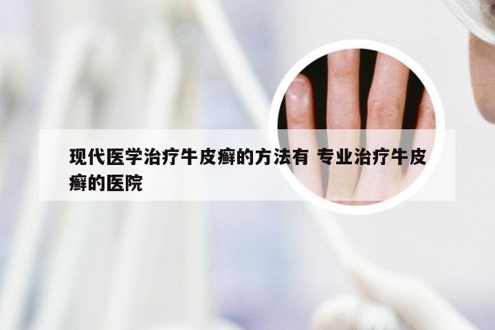 现代医学治疗牛皮癣的方法有 专业治疗牛皮癣的医院