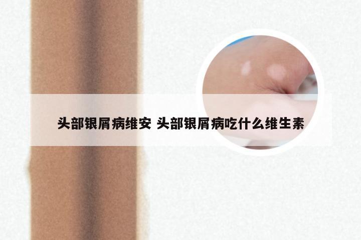 头部银屑病维安 头部银屑病吃什么维生素