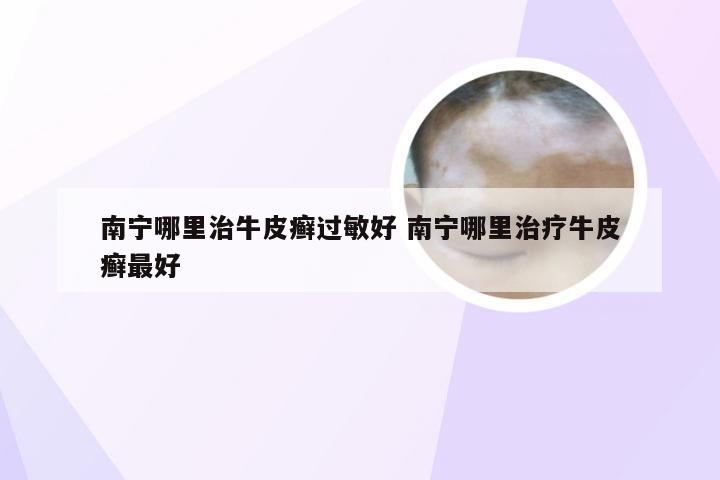 南宁哪里治牛皮癣过敏好 南宁哪里治疗牛皮癣最好