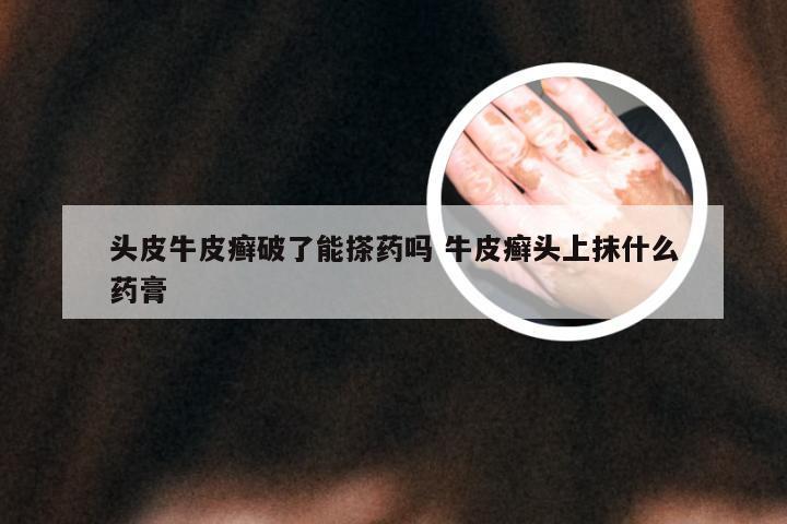 头皮牛皮癣破了能搽药吗 牛皮癣头上抹什么药膏