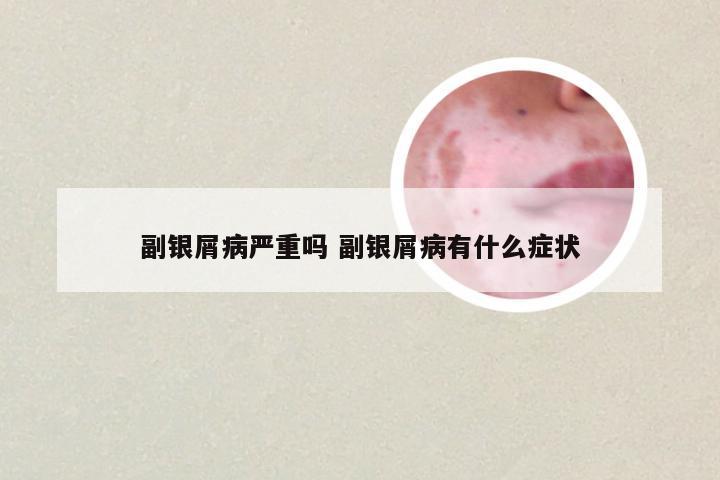 副银屑病严重吗 副银屑病有什么症状