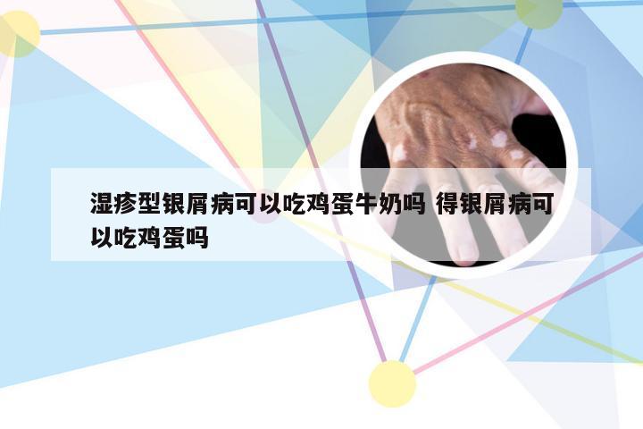 湿疹型银屑病可以吃鸡蛋牛奶吗 得银屑病可以吃鸡蛋吗