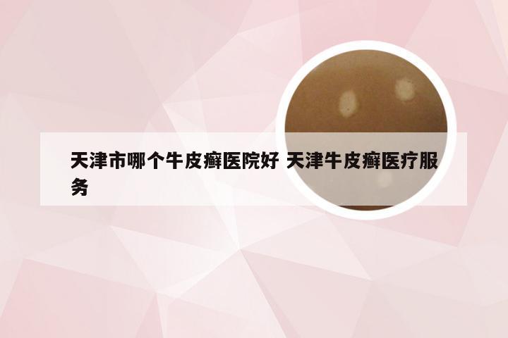 天津市哪个牛皮癣医院好 天津牛皮癣医疗服务