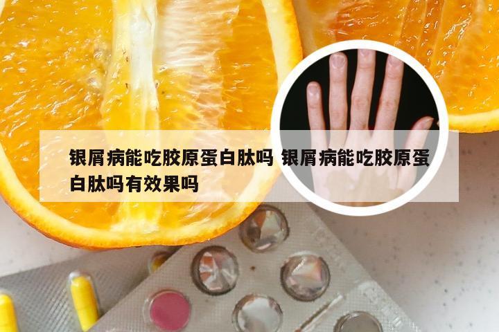 银屑病能吃胶原蛋白肽吗 银屑病能吃胶原蛋白肽吗有效果吗