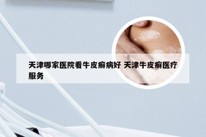 天津哪家医院看牛皮癣病好 天津牛皮癣医疗服务