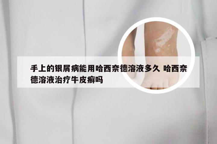手上的银屑病能用哈西奈德溶液多久 哈西奈德溶液治疗牛皮癣吗