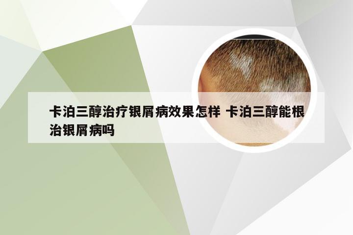 卡泊三醇治疗银屑病效果怎样 卡泊三醇能根治银屑病吗
