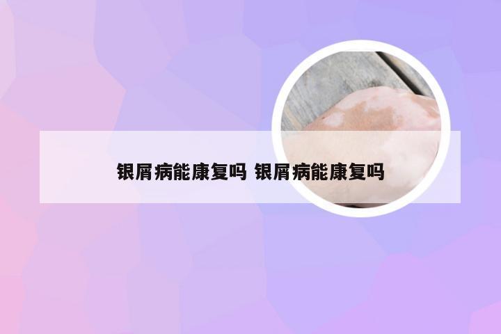 银屑病能康复吗 银屑病能康复吗