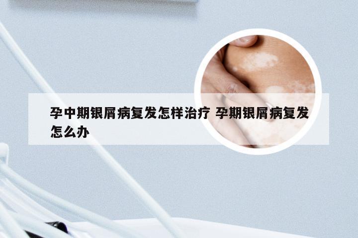 孕中期银屑病复发怎样治疗 孕期银屑病复发怎么办