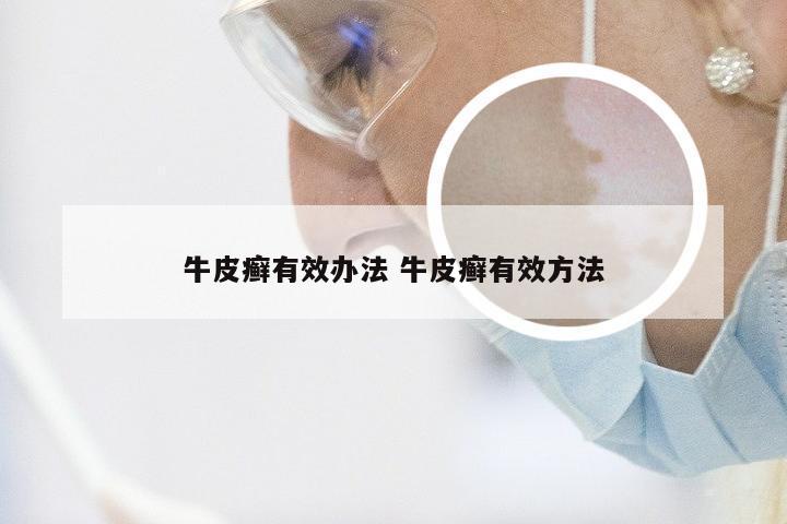 牛皮癣有效办法 牛皮癣有效方法