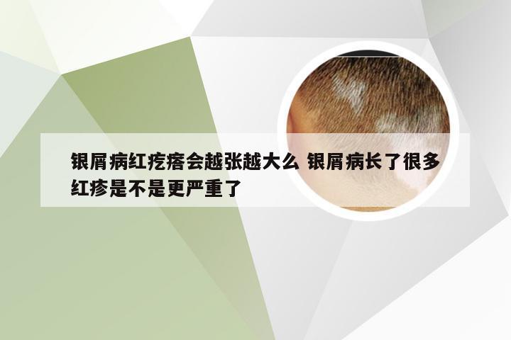 银屑病红疙瘩会越张越大么 银屑病长了很多红疹是不是更严重了