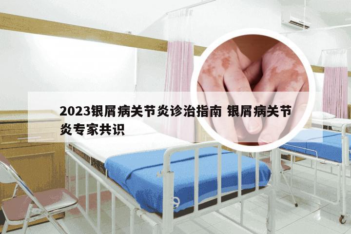 2023银屑病关节炎诊治指南 银屑病关节炎专家共识
