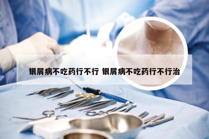 银屑病不吃药行不行 银屑病不吃药行不行治