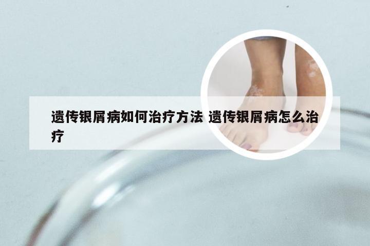遗传银屑病如何治疗方法 遗传银屑病怎么治疗
