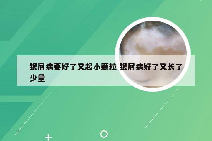 银屑病要好了又起小颗粒 银屑病好了又长了少量