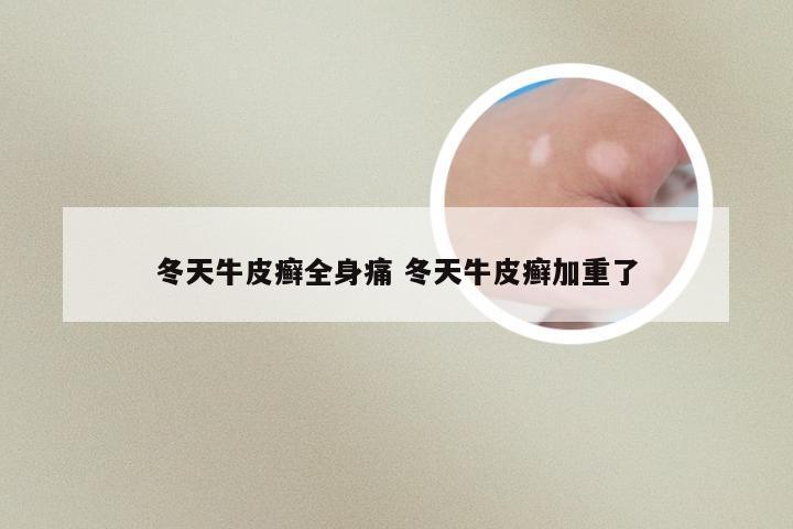 冬天牛皮癣全身痛 冬天牛皮癣加重了