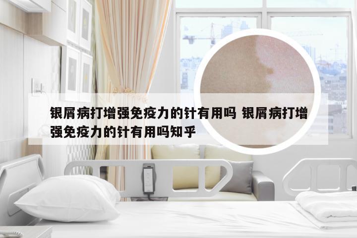 银屑病打增强免疫力的针有用吗 银屑病打增强免疫力的针有用吗知乎