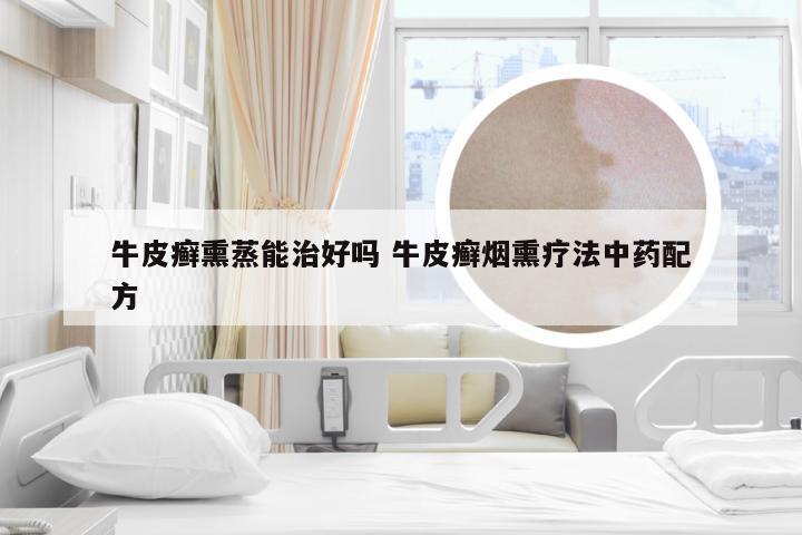 牛皮癣熏蒸能治好吗 牛皮癣烟熏疗法中药配方