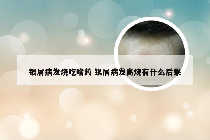 银屑病发烧吃啥药 银屑病发高烧有什么后果
