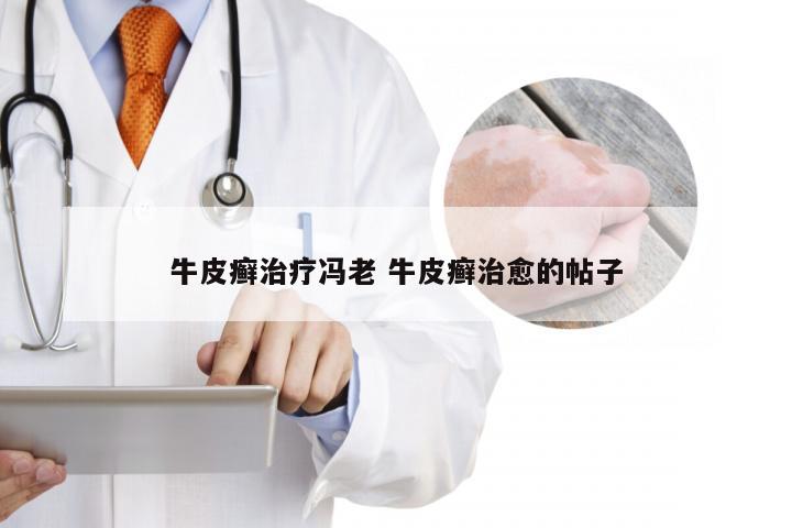 牛皮癣治疗冯老 牛皮癣治愈的帖子