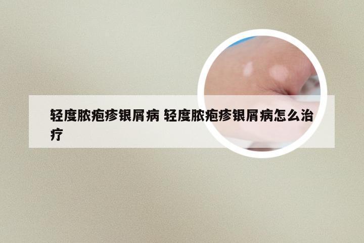 轻度脓疱疹银屑病 轻度脓疱疹银屑病怎么治疗