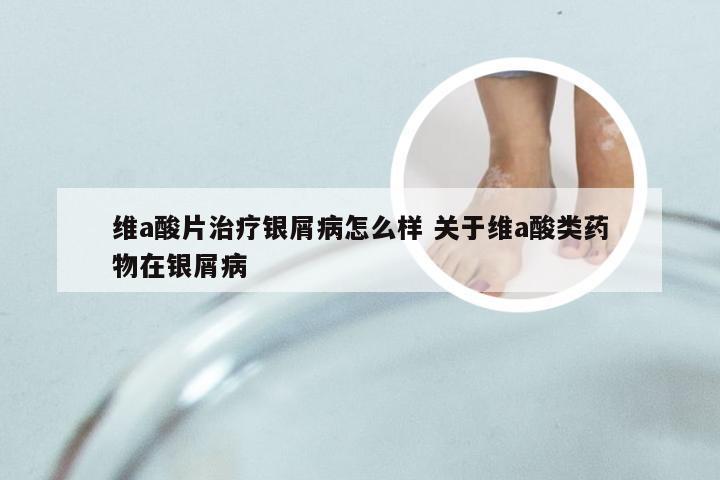 维a酸片治疗银屑病怎么样 关于维a酸类药物在银屑病