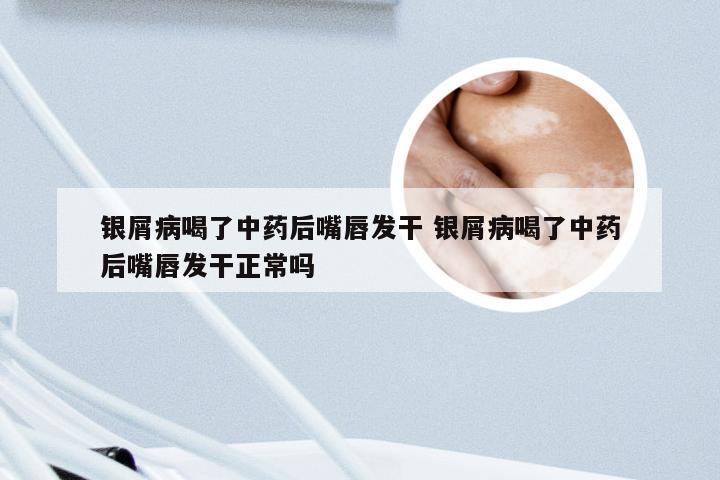 银屑病喝了中药后嘴唇发干 银屑病喝了中药后嘴唇发干正常吗