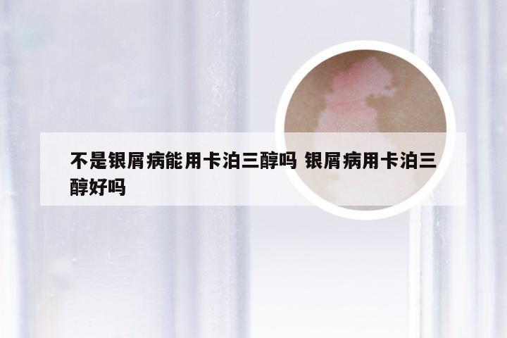 不是银屑病能用卡泊三醇吗 银屑病用卡泊三醇好吗