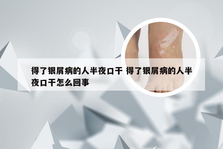 得了银屑病的人半夜口干 得了银屑病的人半夜口干怎么回事