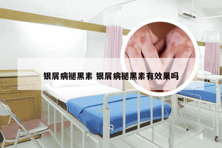 银屑病褪黑素 银屑病褪黑素有效果吗