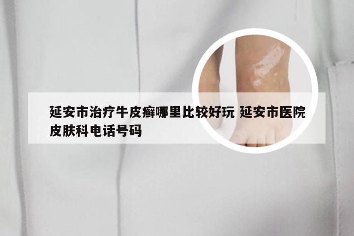 延安市治疗牛皮癣哪里比较好玩 延安市医院皮肤科电话号码
