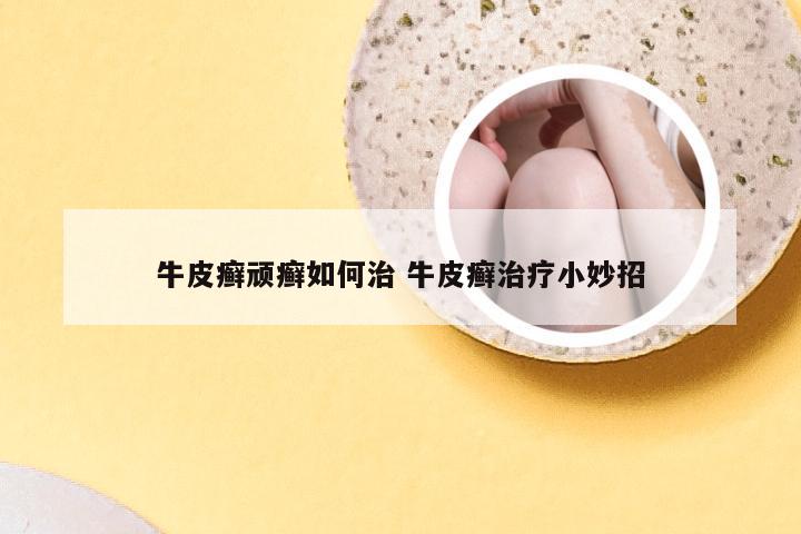 牛皮癣顽癣如何治 牛皮癣治疗小妙招