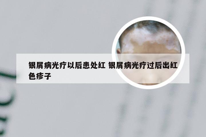 银屑病光疗以后患处红 银屑病光疗过后出红色疹子